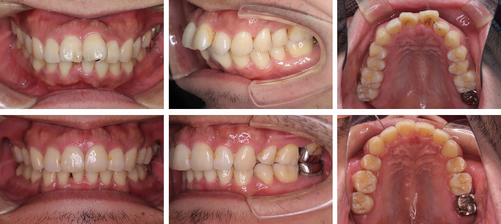 出っ歯の矯正治療のビフォーアフター
